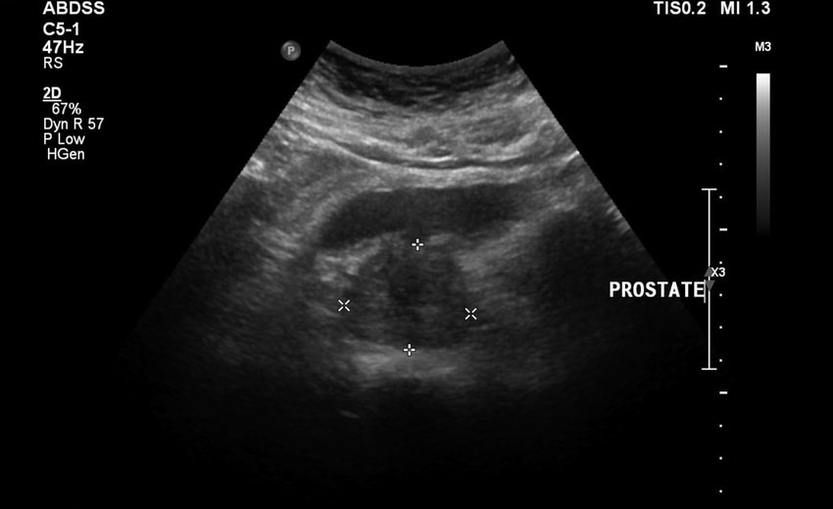 Ultrazvučni prostatitis prije uzimanja zxcvbnmqwert