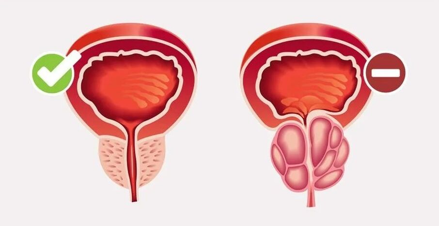 Prostatitis kod muškaraca