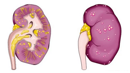 O čemu vodi akutni prostatitis