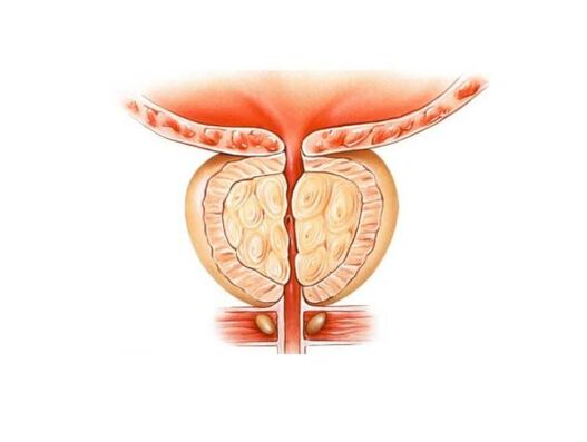 Povećana prostata s prostatitisom